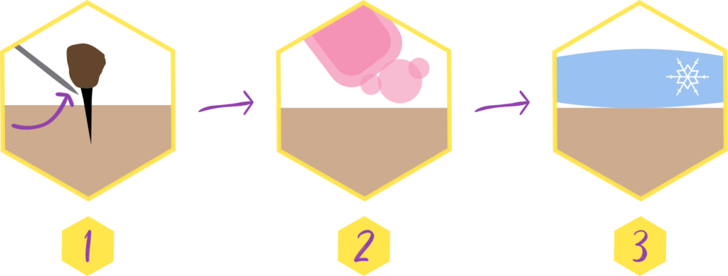 Selection from infographic showing treatment steps needed to remove stinger, wash area, and then cool with a compress.